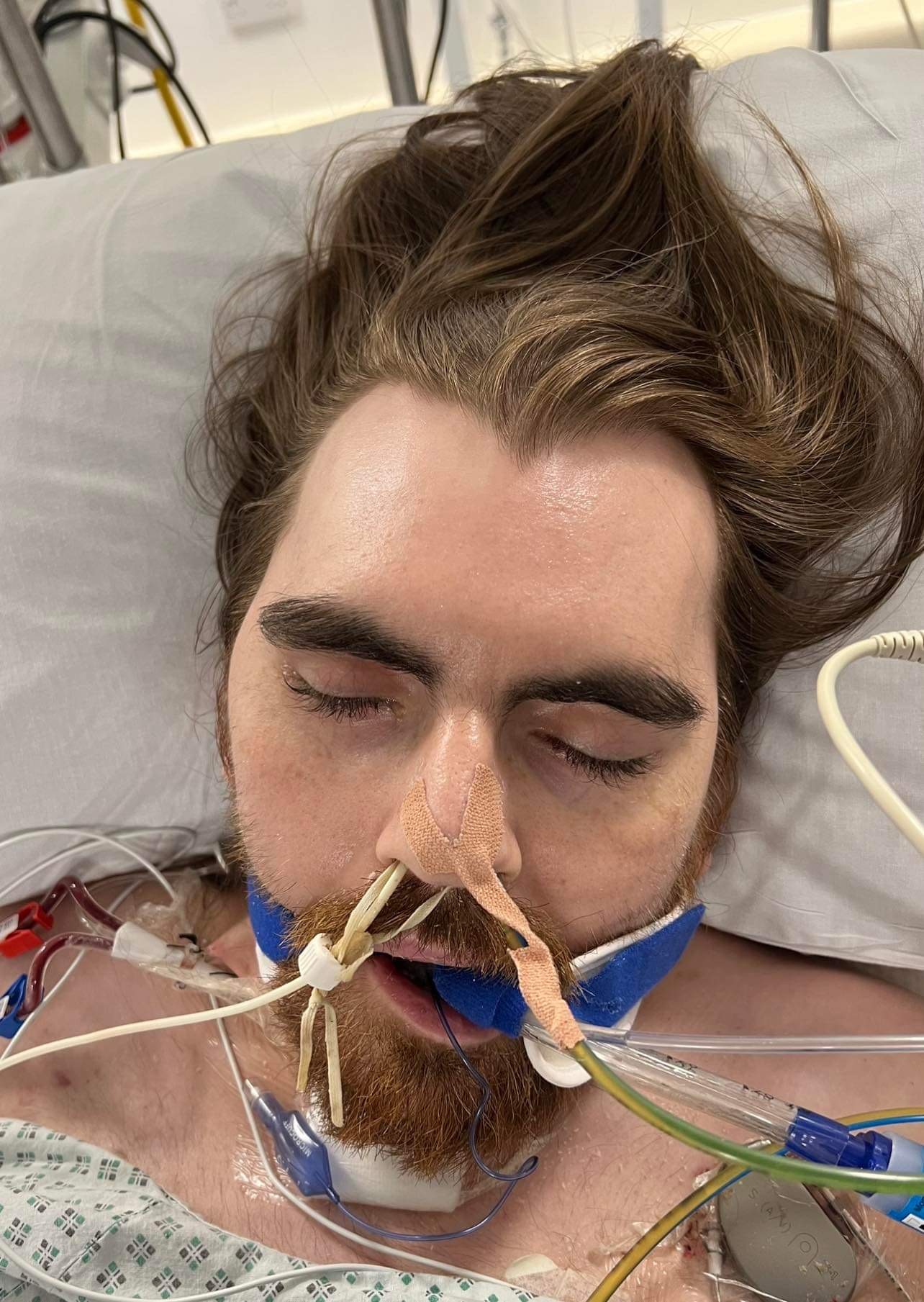 Sam in Morriston's ICU