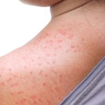 Measles