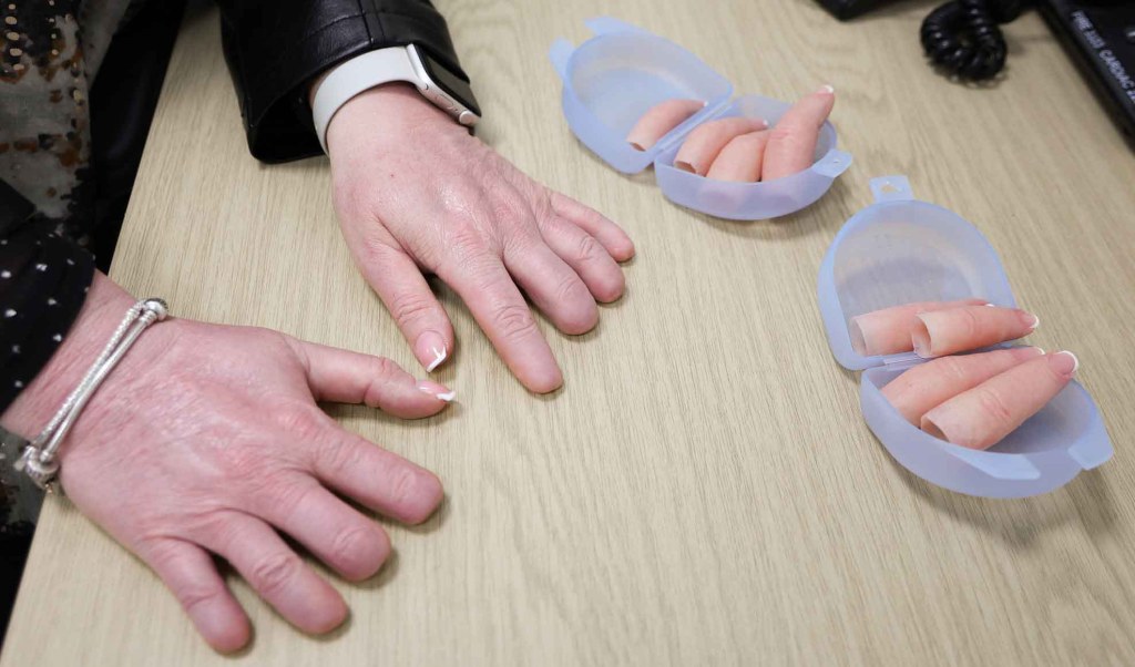 A close-up of Louise's damaged fingers and the prosthetic replacements