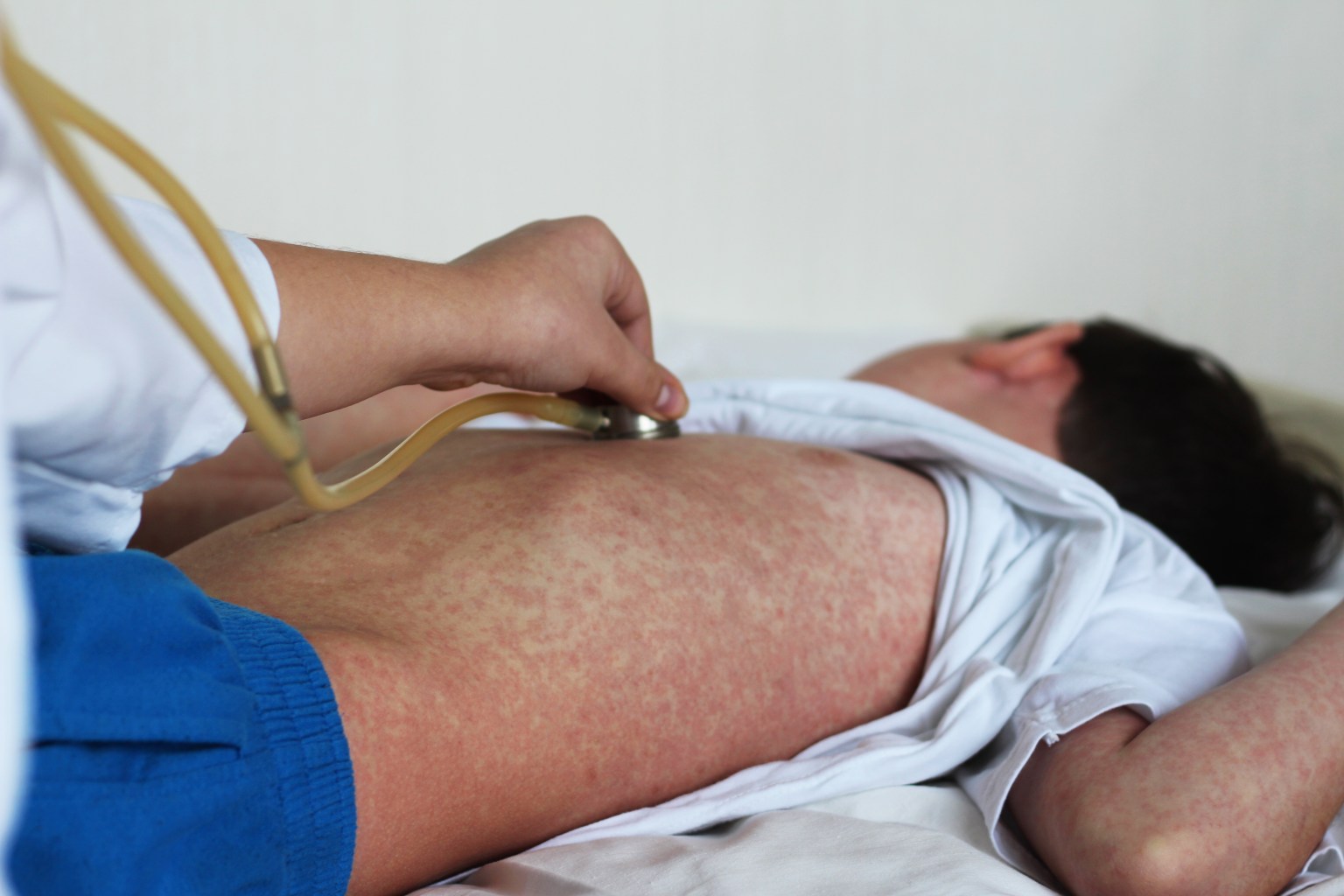 Measles,Rash.,Doctor,And,Patient