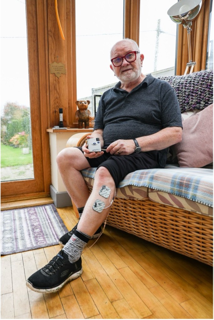 Malcolm Sims showing the FES device attached to his leg during the STEPS II Parkinson’s trial.