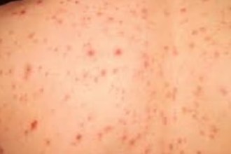 A close-up medical image illustrating meningitis awareness, used to highlight symptoms and the importance of vaccination