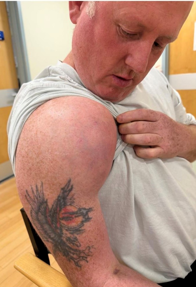 Lee Brain showing his shoulder, where the sarcoma developed