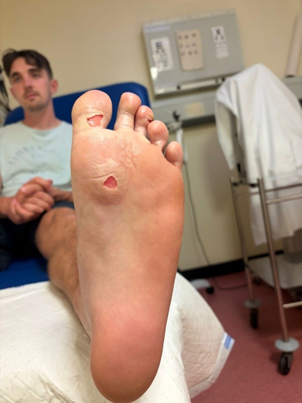 The sole of a foot with two deep open burns, one on the ball and one on a toe, photographed in a hospital treatment room
